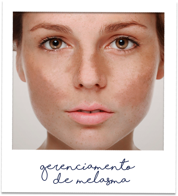 gerenciamento de melasma